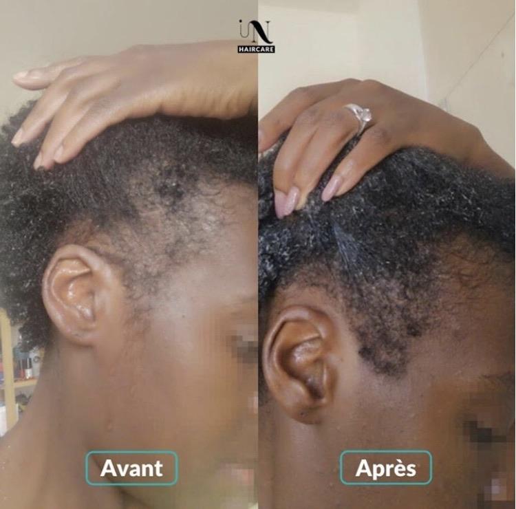 Before and after Hair Growth Cure 1 month 